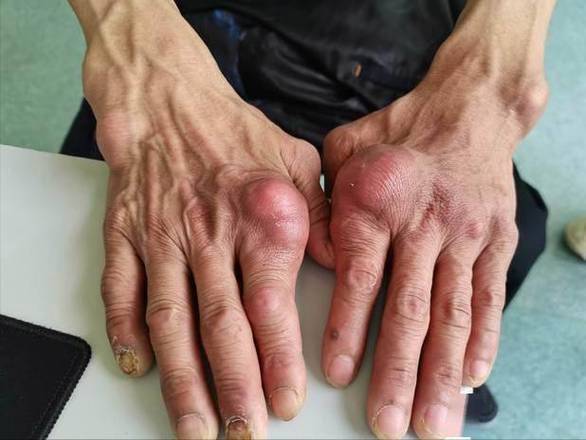 全世界痛风病人多少