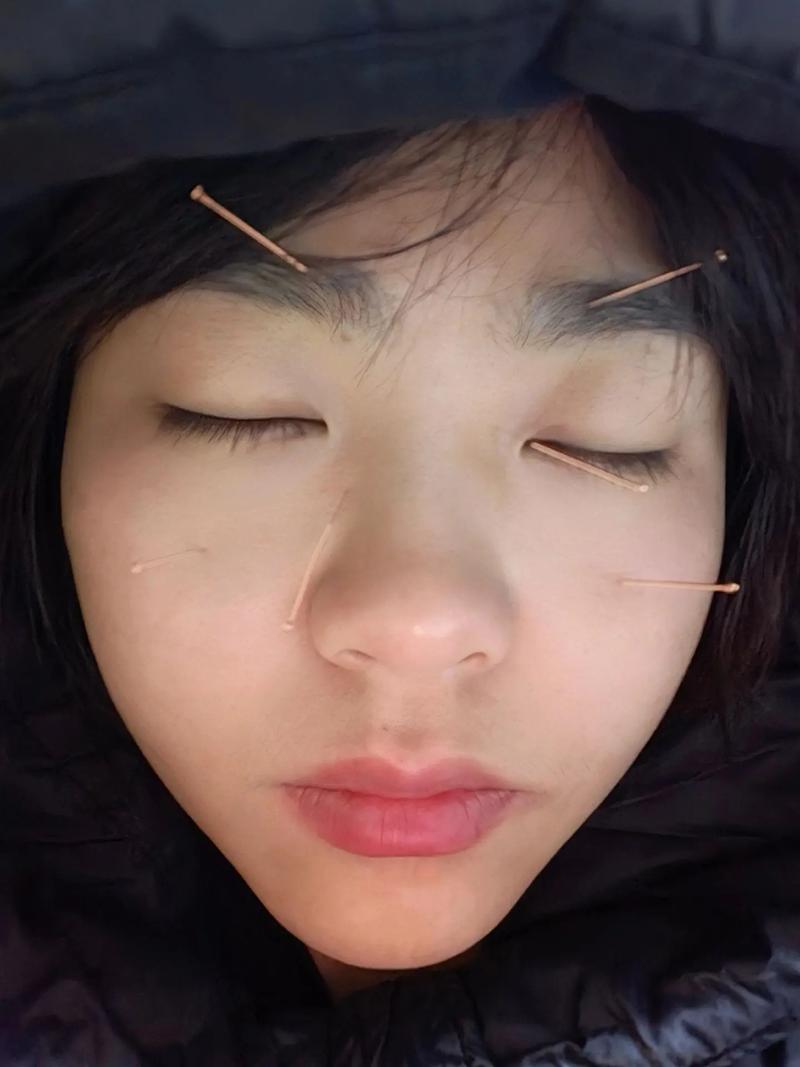 针灸放血治疗黑眼圈