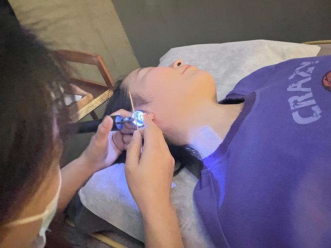 针灸放血治疗黑眼圈