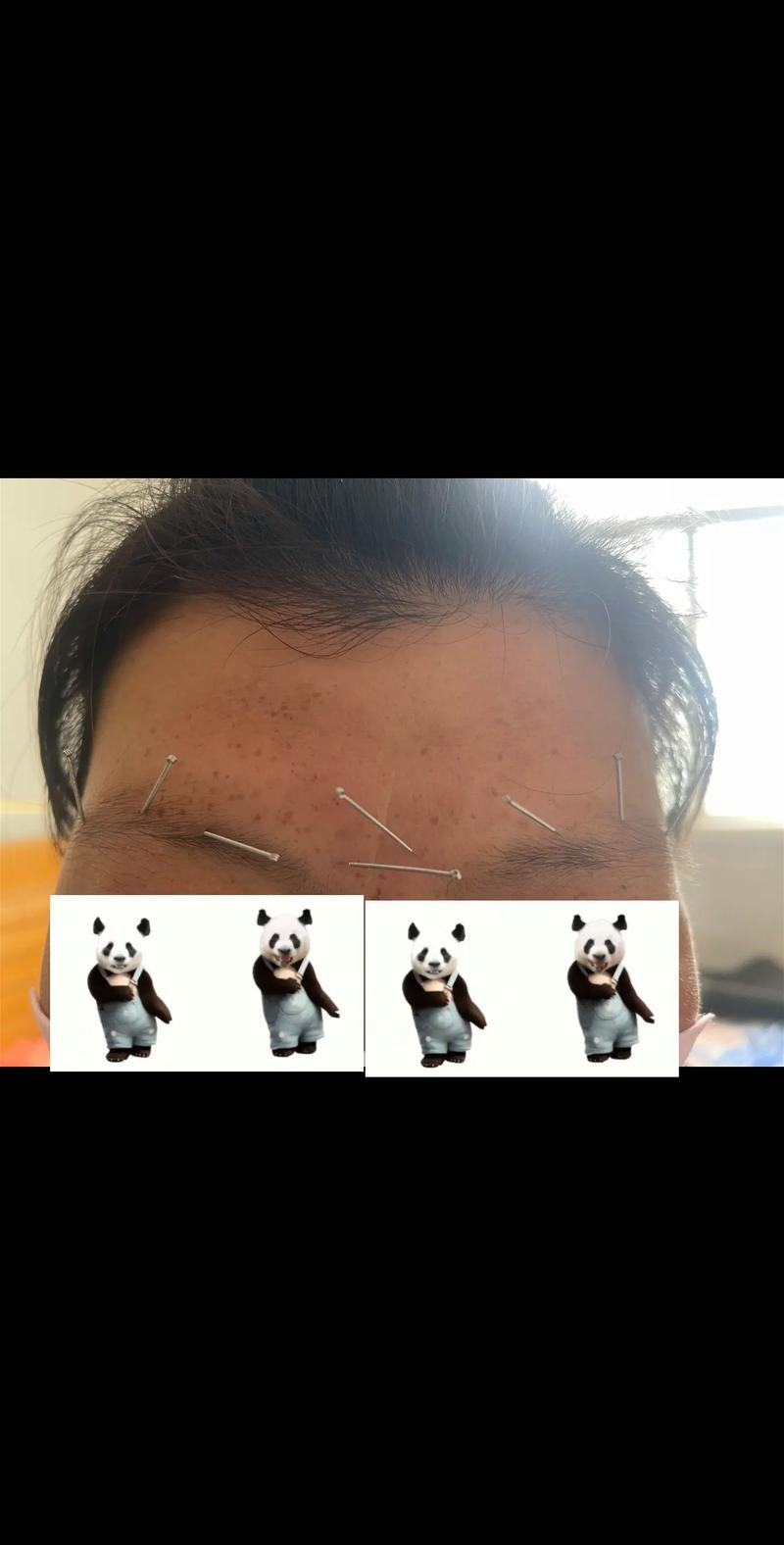 针灸放血治疗黑眼圈