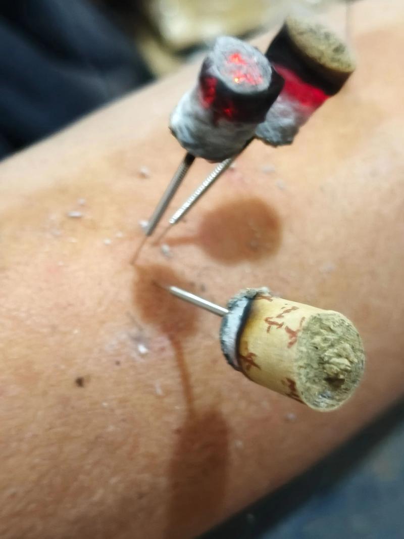 温州哪里有针灸埋线