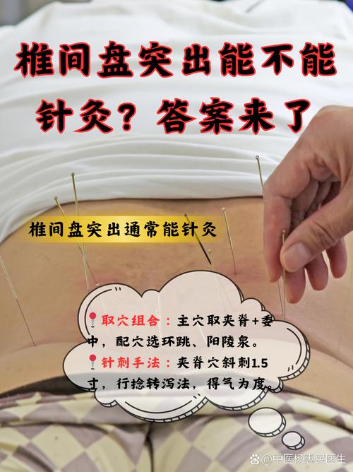 腰突针灸多久能管用