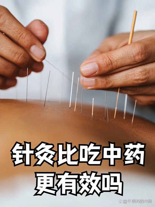 不懂中医能学针灸吗