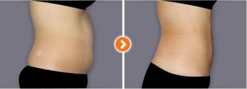 腹部吸脂上海美莱安全