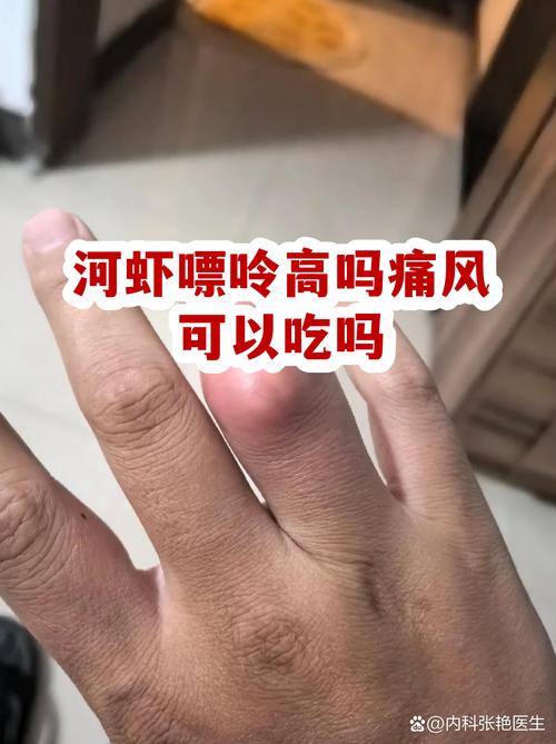 痛风可以吃的水产品