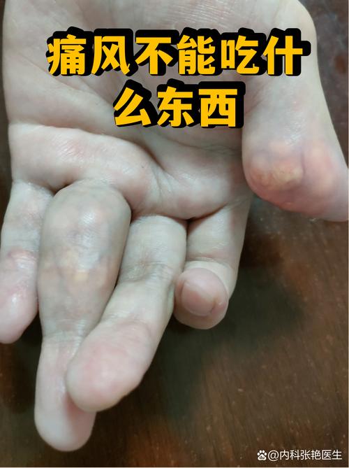 手关节痛风吃什么好