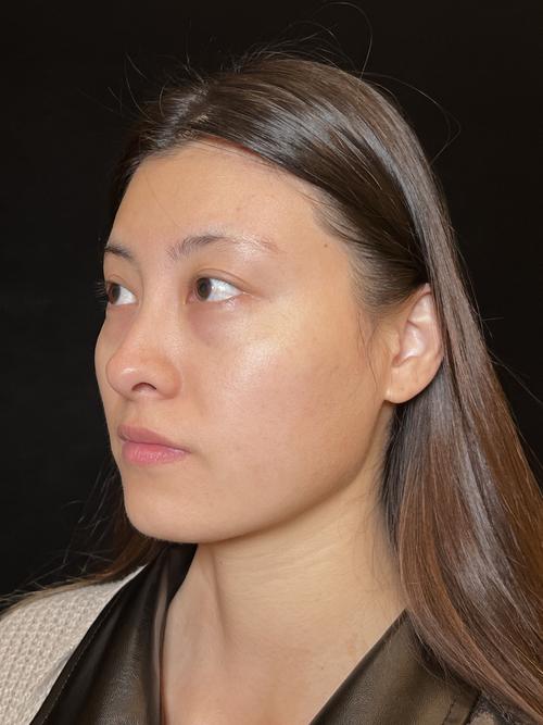 祛黑眼袋厦门美莱安全