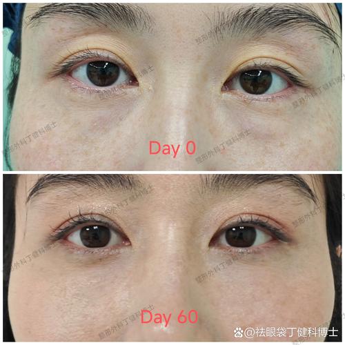 祛黑眼袋厦门美莱安全