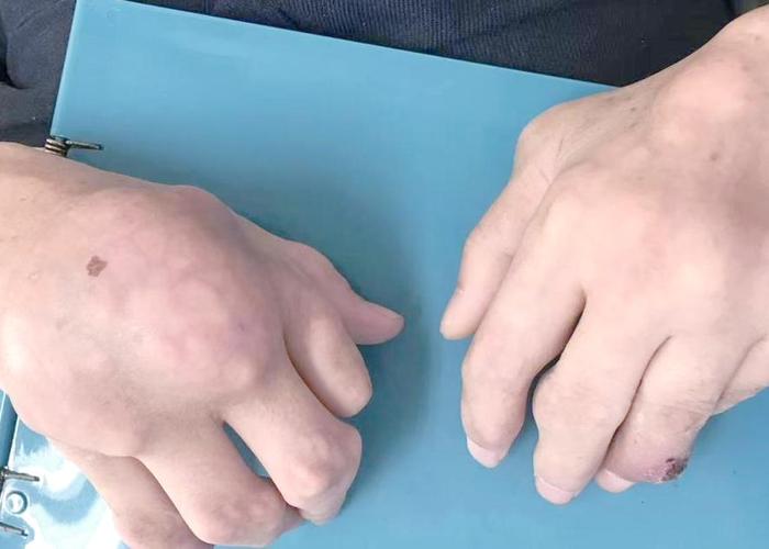 中西医结合治疗痛风