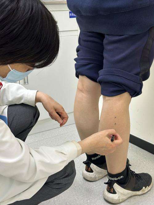 小腿针灸埋线部位肿