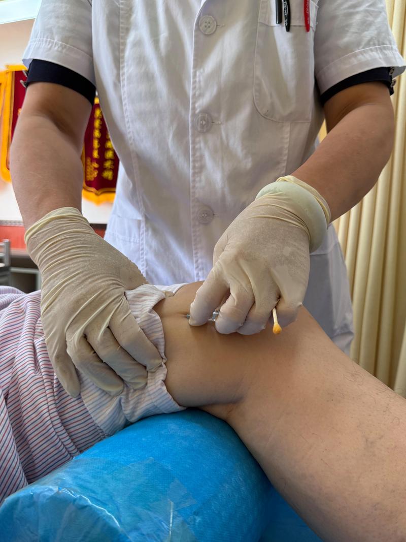 扎针灸会引起血肿吗