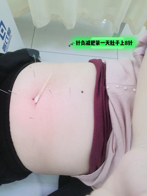 针灸减肥用几寸的针