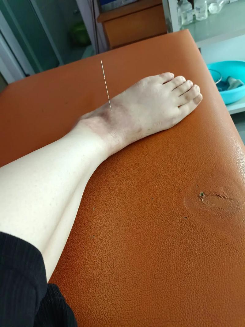 扭伤脚踝针灸治疗吗