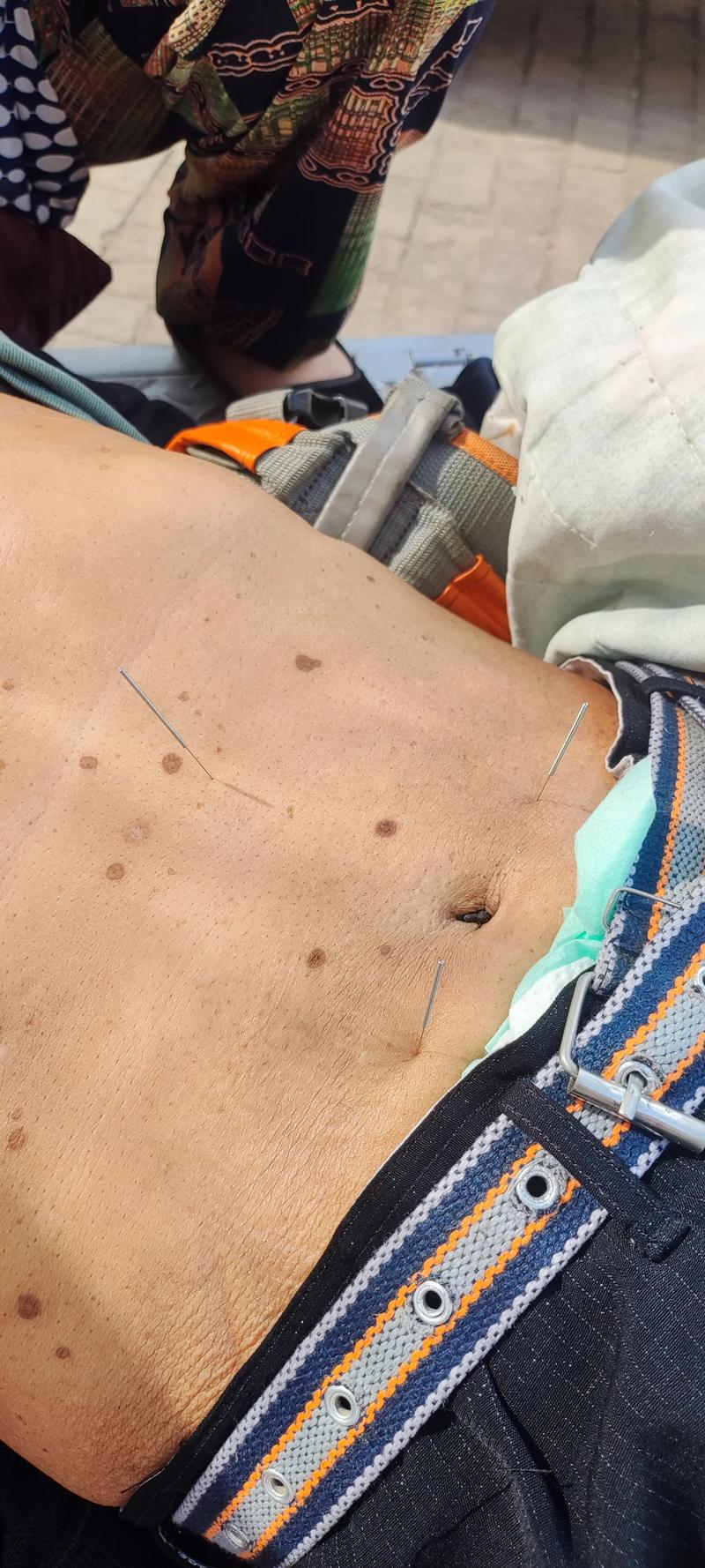 针灸治疗急性肠胃炎