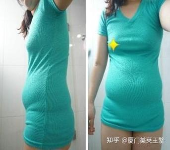 吸脂价格厦门美莱安全