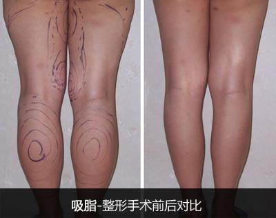 吸脂价格厦门美莱安全