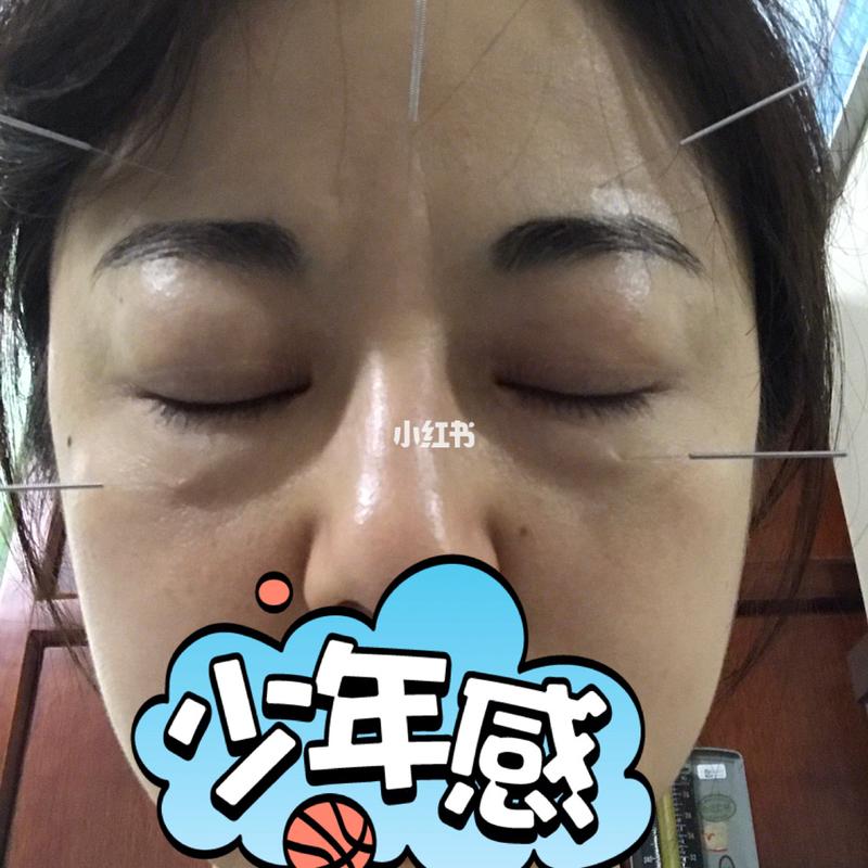 针灸贴祛眼袋烧痛感