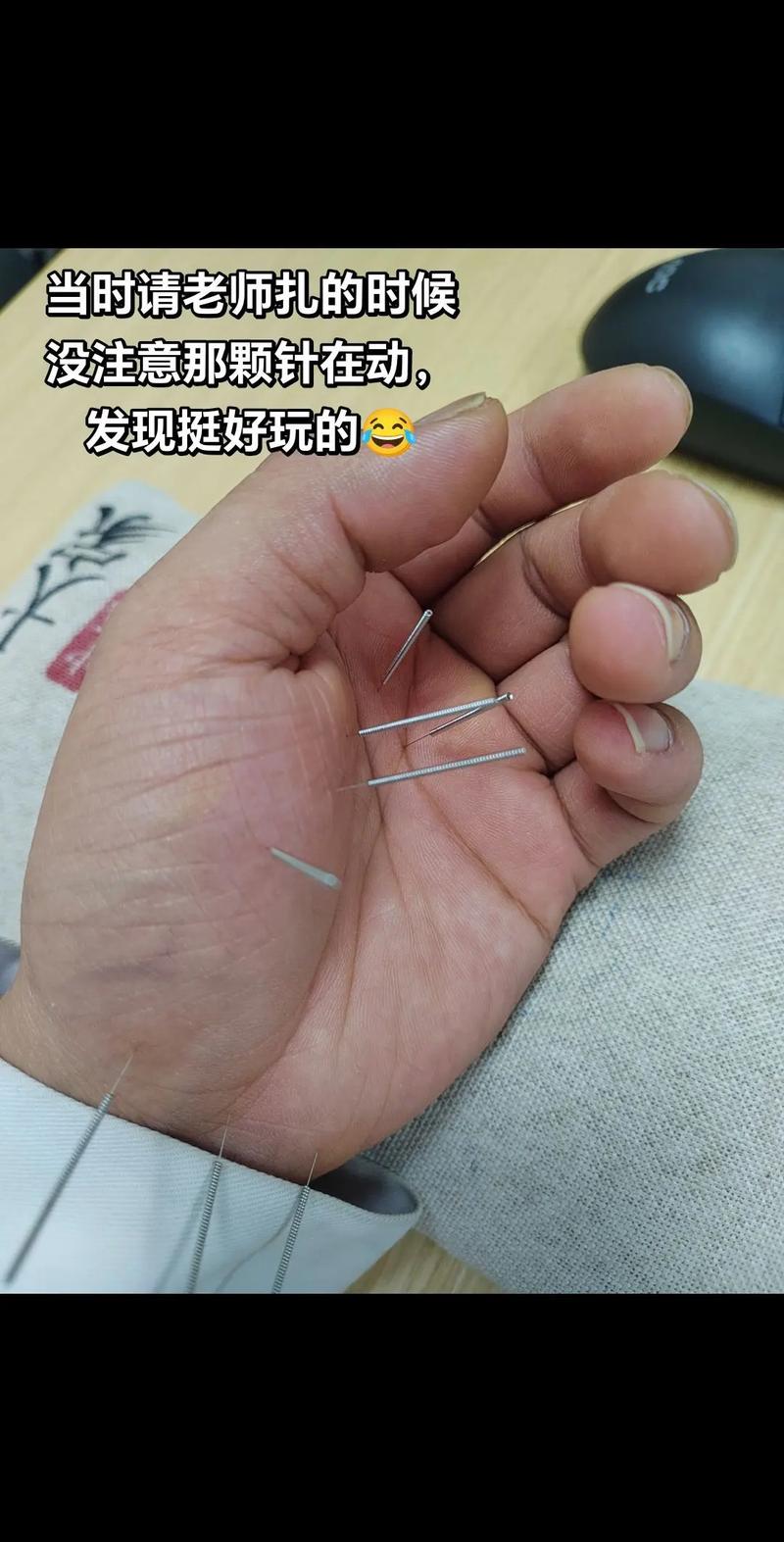 手心针灸是治什么病