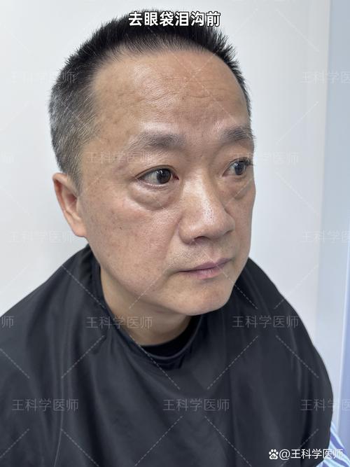 祛除眼袋厦门美莱安全