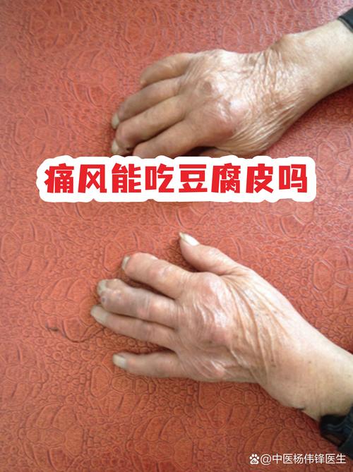 痛风病人能吃豆腐么