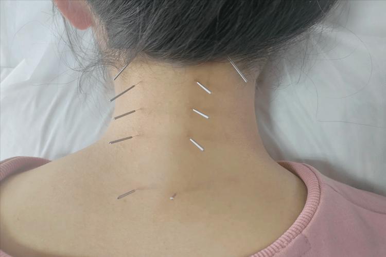 颈椎病针灸治疗进展