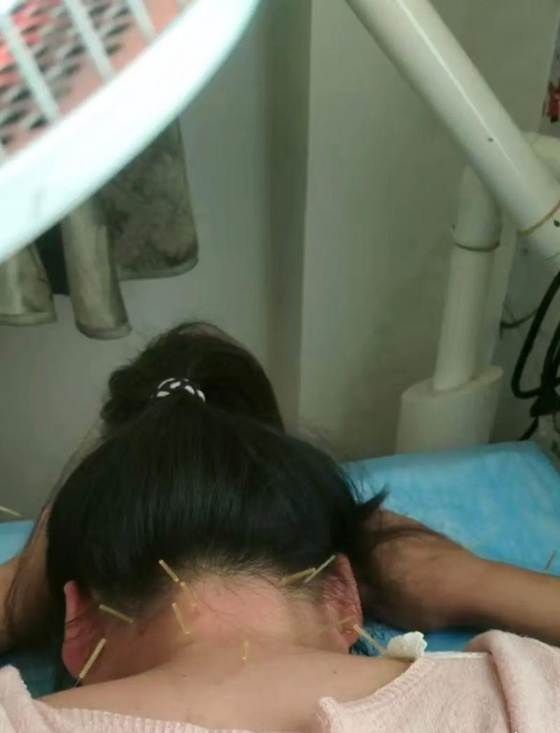 颈椎病针灸治疗进展