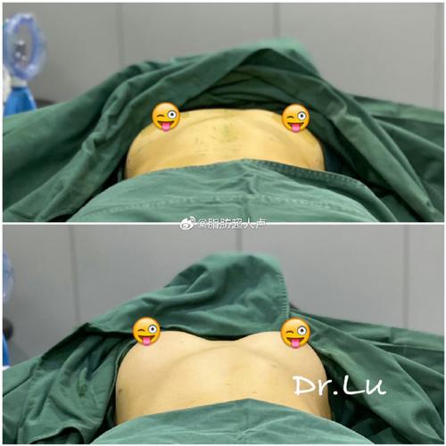 吸脂丰胸上海美莱安全