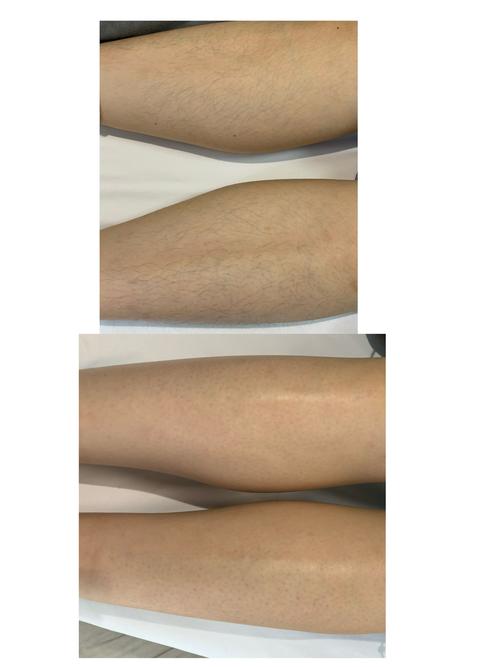 光子脱毛上海美莱安全