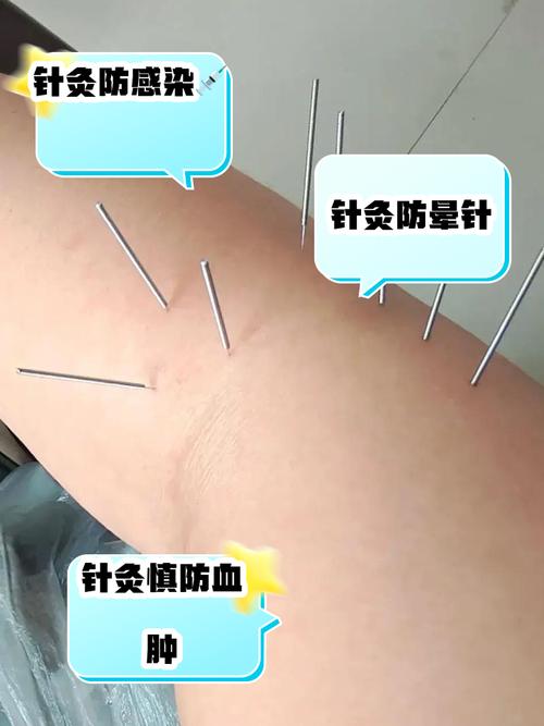 产后腿凉针灸会好吗