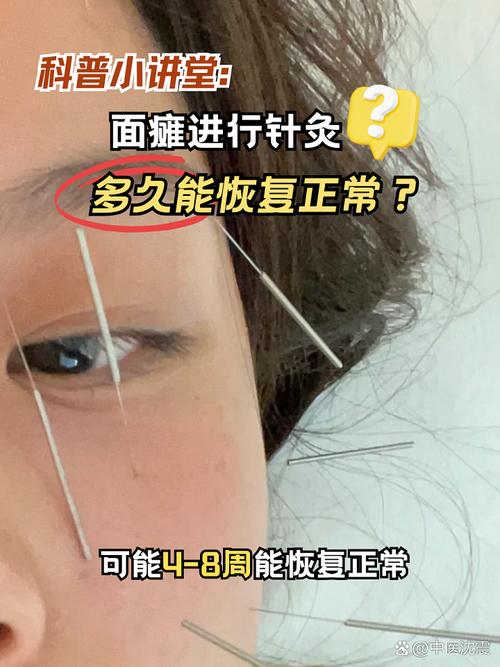 针灸会损伤面神经吗