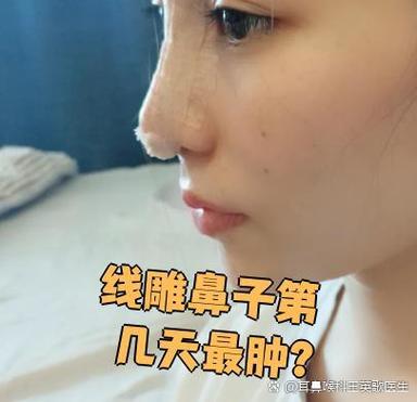 线雕隆鼻上海美莱安全