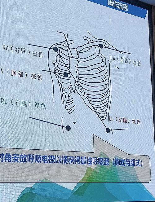 床旁胸片辐射安全距离