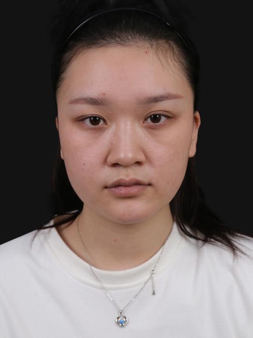 假体隆鼻厦门美莱安全