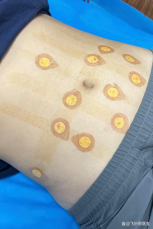 抚顺矿务局针灸减肥