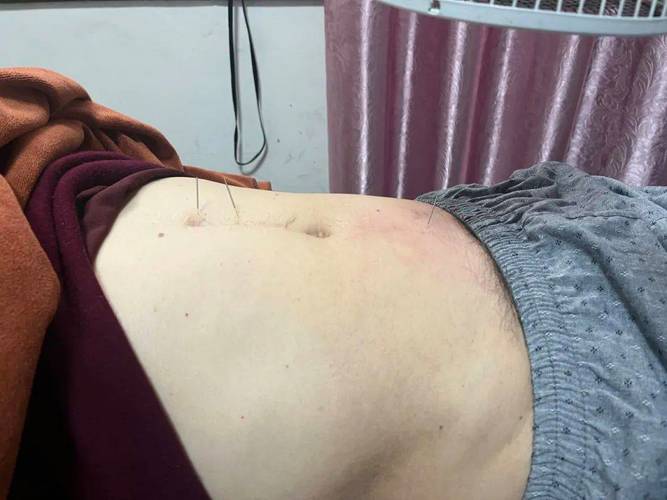 前列腺针灸图片大全