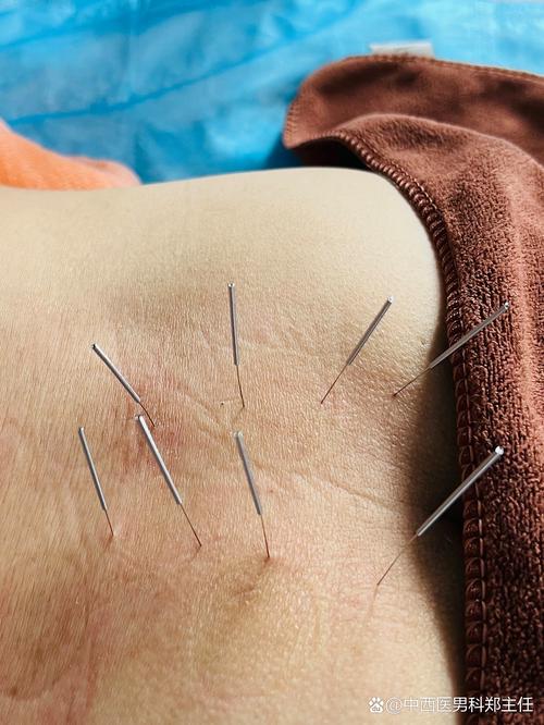 前列腺针灸图片大全