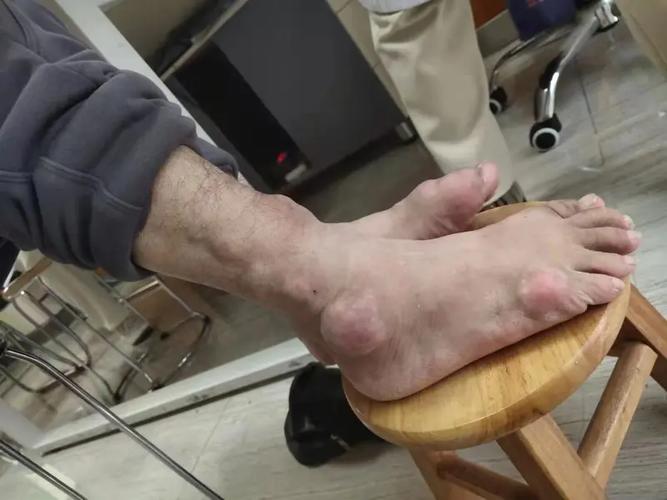 糖皮质激素治疗痛风