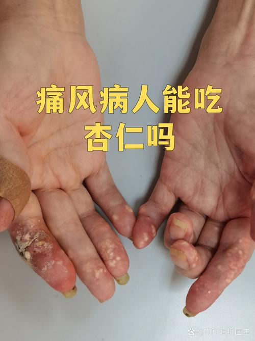 痛风病人能吃醋豆吗