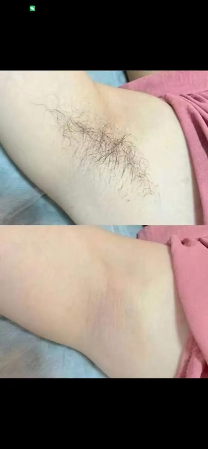 宁波脱毛宁波美莱安全