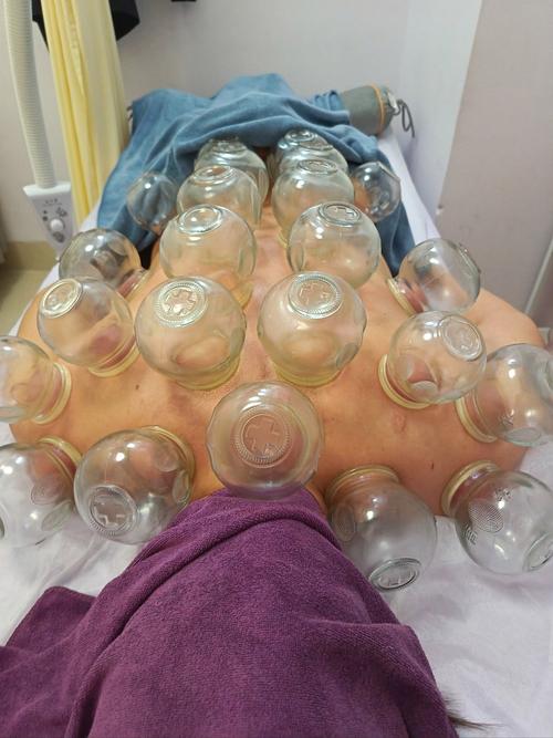 淮南哪里拔罐针灸好