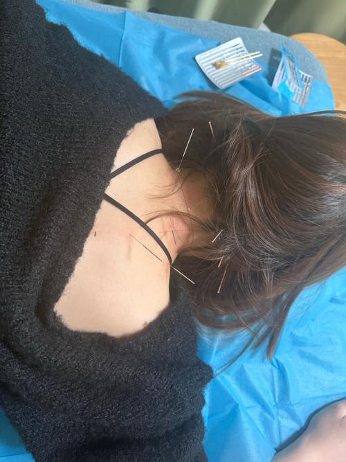 针灸埋线后头晕恶心