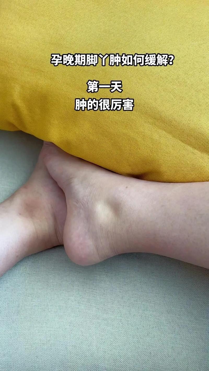 怀孕痛风脚肿怎么办