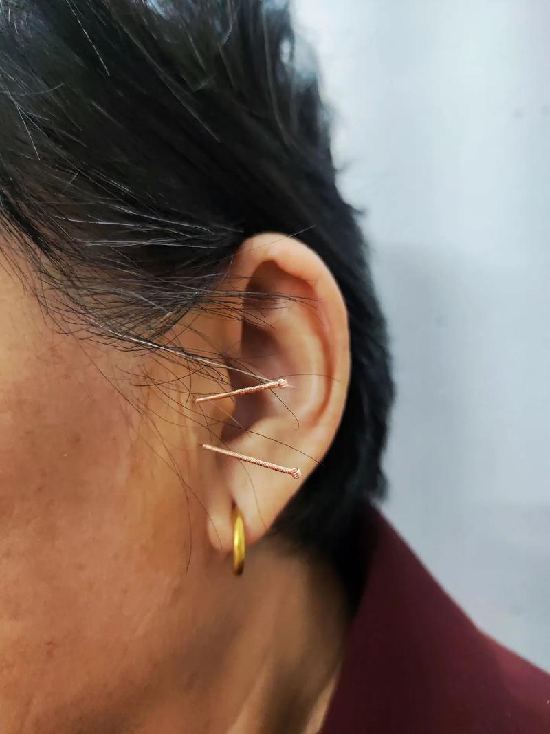 针灸治耳鸣有效果吗