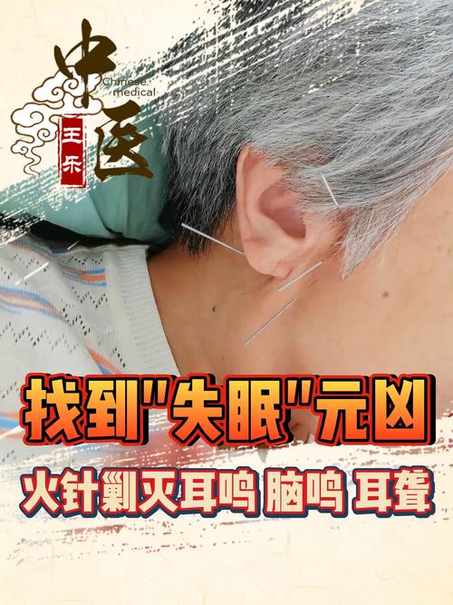 针灸治耳鸣有效果吗