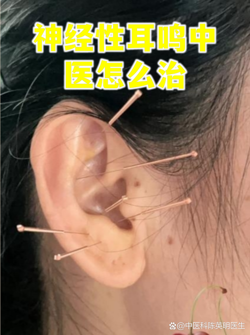 针灸治耳鸣有效果吗