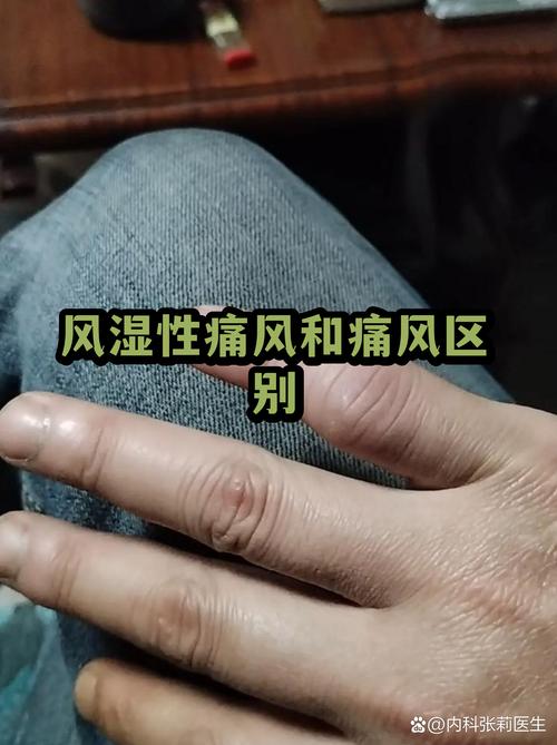 痛风和风湿有区别吗