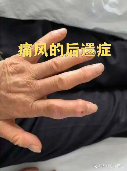 痛风会表现在后背吗