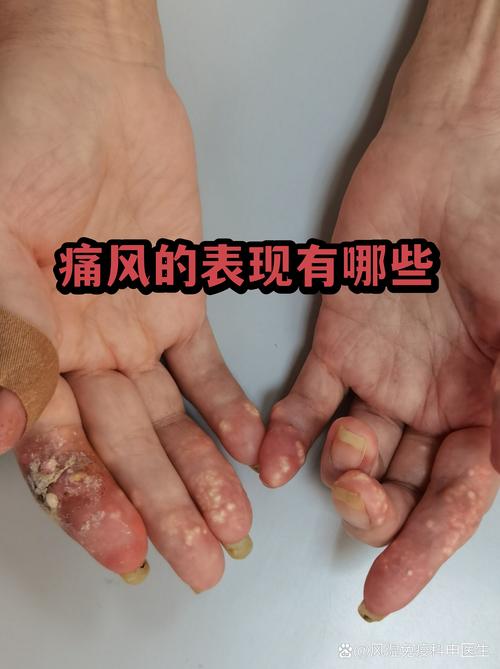 痛风会表现在后背吗