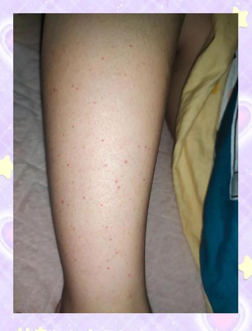 紫癜可以针灸治疗吗