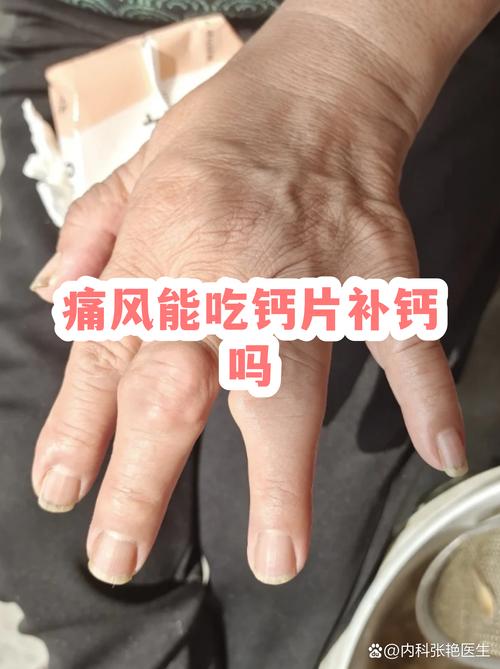 痛风能吃全脂奶粉吗
